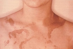 родимые пятна в виде континента и островов