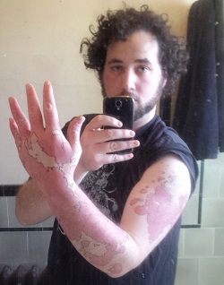 родимое пятно на руке в виде карты