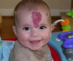 родимое пятно на лбу