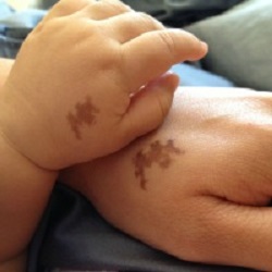 одинаковые родимые пятна