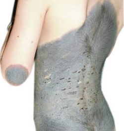 родимое пятно на теле