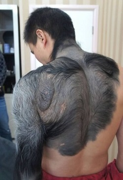 родимое пятно на торсе